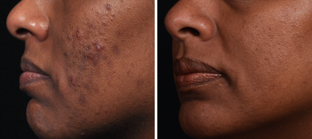 Chemical Peel | Lenox Laser & Esthetics